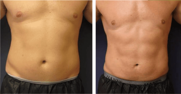 -Emsculpt-BA-2-600x312