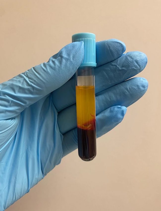 PRP vial 1